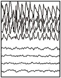 Partiella anfall EEG