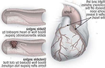 Stabil och instabil angina