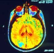 En MRI av hjärnan kan visa om cancern har spridit sig (metastaserat) där.