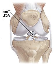 Framifrån av knäleden som visar muskler, ben och ligament med partiell rip av främre korsbandet.