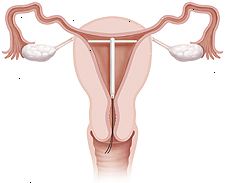 Tvärsnitt av livmoder och vagina visar IUD på plats inne i livmodern.