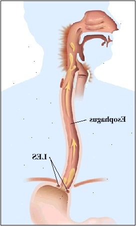 Disposition av en mänsklig figur som visar anatomi övre matsmältningssystem från munnen till magsäcken. Matstrupen går genom membranet för att ansluta till magen. Svag LES är öppen och pilar visar flödet av maginnehåll upp i matstrupen och baksidan av halsen. Tillbaka i halsen är inflammerad.