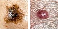 Foto jämföra normala och melanom mol visar asymmetri