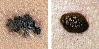Foto jämföra normala och melanom mol visar gräns oegentligheter