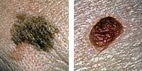 Foto jämföra normala och melanom mol visar diameter