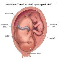 Illustration av en tvilling födsel, tvilling till twin transfusion