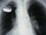 Röntgen av en enda kammare implanterad pacemaker