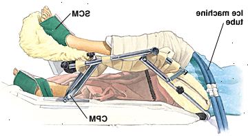 Person som ligger i sjukhussäng med ett knä som stöds av kontinuerlig passiv rörelse maskin. Knä slås in, och ismaskin rören går under omslag. Sekventiell kompressions manschetter är lindade runt båda fötterna.