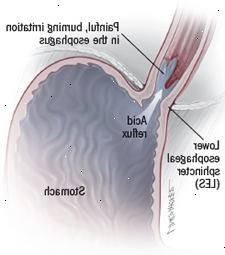 Halsbränna illustration