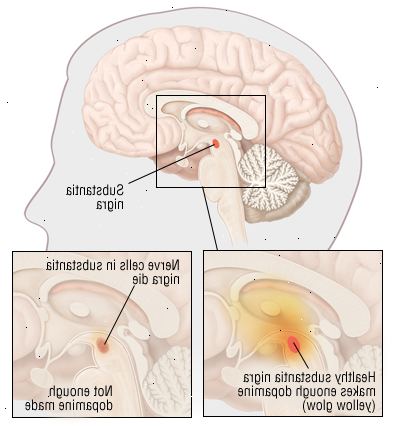 Parkinsons