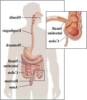 Varje del av mag-tarmkanalen, från munnen till anus, kan påverkas. Det finns ofta förekommande i tunntarmen och kolon möts.