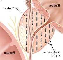 Närbild tvärsnitt av urinblåsa, prostata och rektum. Radioaktiva frön implanteras i hela prostata.