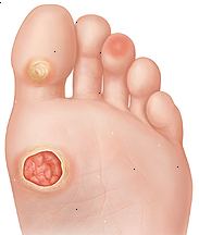 Sula av foten visar sår på tramp fots, förhårdnader på basen av stortån, och varm plats på pad av tredje tån.