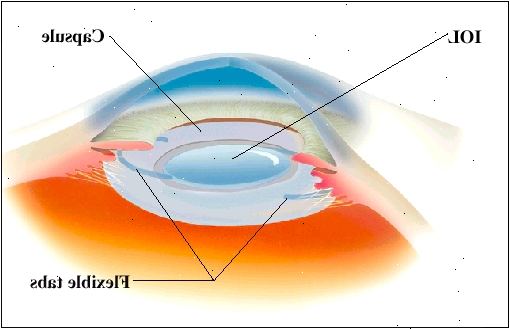 IOL utvecklar sig som det sätts in i ögats naturliga kapsel. Flexibla flikar hålla lOL på plats.