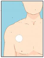 Applicera plåstret på en torr plats på bröstkorgen, övre delen av ryggen eller överarmen.
