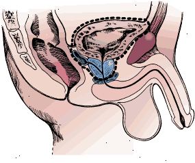 Kirurgiska gränser radikal cystektomi i en man. Provet innefattar blåsan, prostatan och sädesblåsorna.