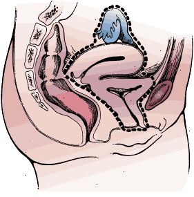 Kirurgiska gränser radikal cystektomi i en kvinna. Provet innefattar blåsan och hela urinröret, livmoder, äggstockar, äggledarna och den främre väggen av slidan.