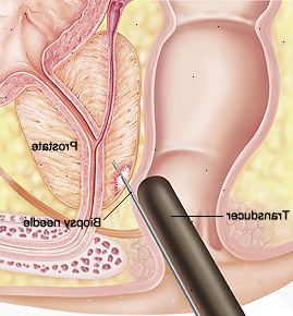 Närbild tvärsnitt av prostata och rektum. Transducer införes i ändtarmen och nålen förs in i prostatan.