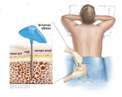 Benmärg aspiration och biopsi, teckning visar en patient ligger med ansiktet nedåt på ett bord och en Jamshidi nål (en lång, ihålig nål) som sätts in i höftbenet. Inset visar Jamshidi nålen införes genom huden in i benmärgen av höftbenet.