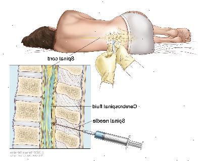 Lumbalpunktion. En patient som ligger i en krökt ställning på ett bord. Efter ett litet område på den nedre delen av ryggen är bedövad är en spinalnål (en lång, tunn nål) införes i den nedre delen av ryggraden för att ta bort cerebrospinalvätska (CSF, som visas i blått). Fluiden kan skickas till ett laboratorium för provning.