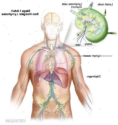 Steg I vuxen Non-Hodgkins lymfom; ritningen visar cancer i en lymfkörtel grupp ovanför membranet. En infällda bilden visar en lymfkörtel med en lymfkärl, en artär och en ven. Lymfomceller som innehåller cancer visas i lymfkörtel.