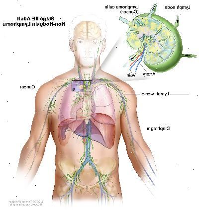 Stage IIE vuxen Non-Hodgkins lymfom; ritningen visar cancer i en lymfkörtel grupp ovanför membranet och i den vänstra lungan. En infällda bilden visar en lymfkörtel med en lymfkärl, en artär och en ven. Lymfomceller som innehåller cancer visas i lymfkörtel.