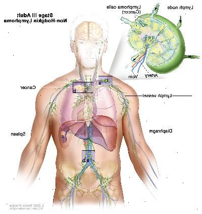 Steg III vuxen non-Hodgkin lymfom. Cancer finns i en eller flera grupper lymfkörtel ovanför och under membranet (a). I steg IIIE är cancer finns i lymfkörtelgrupperna över och under membranet och utanför lymfkörtlarna i en närliggande organ eller område (b). I steg IIIS, cancer finns i lymfkörteln grupper ovanför och under membranet (a) och i mjälten (c). I steg IIIS plus E, är cancer finns i lymfkörteln grupper över och under membranet, utanför lymfkörtlarna i en närliggande organ eller område (b), och i mjälten (c).