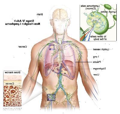 Steg IV vuxen Non-Hodgkins lymfom; ritningen visar cancer i levern, den vänstra lungan, och i en lymfkörtel grupp under diafragman. Hjärnan och pleura visas också. En infällda bilden visar en närbild av cancer sprids genom lymfkörtlar och lymfkärl till andra delar av kroppen. Lymfomceller som innehåller cancer visas inuti en lymfkörtel. Ett annat infällda bilden visar cancerceller i benmärgen.