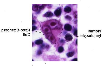 Reed-Sternberg cell. Reed-Sternberg-celler är stora, onormala lymfocyter som kan innehålla mer än en kärna. Dessa celler finns i Hodgkin lymfom.