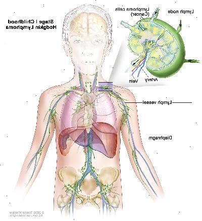 Steg I barndom Hodgkin lymfom, ritning visar cancer i en lymfkörtel grupp ovanför membranet. En infällda bilden visar en lymfkörtel med en lymfkärl, en artär och en ven. Lymfomceller som innehåller cancer visas i lymfkörtel.