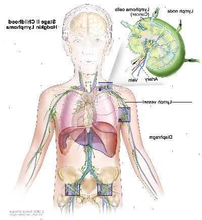 Steg II barndom Hodgkin lymfom; ritningen visar cancer i lymfkörtel grupper ovanför och under membranet. En infällda bilden visar en lymfkörtel med en lymfkärl, en artär och en ven. Lymfomceller som innehåller cancer visas i lymfkörtel.