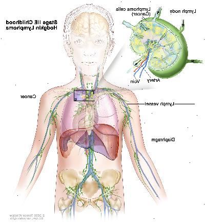 Stage IIE barndom Hodgkin lymfom, ritning visar cancer i en lymfkörtel grupp ovanför membranet och i vänster lunga. En infällda bilden visar en lymfkörtel med en lymfkärl, en artär och en ven. Lymfomceller som innehåller cancer visas i lymfkörtel.