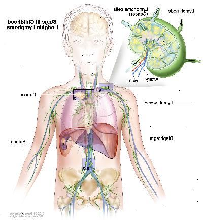 Steg III barndom Hodgkin lymfom. Cancer finns i en eller flera grupper lymfkörtel ovanför och under membranet (a). I steg IIIE är cancer finns i lymfkörtelgrupperna över och under membranet och utanför lymfkörtlarna i en närliggande organ eller område (b). I steg IIIS, cancer finns i lymfkörteln grupper ovanför och under membranet (a) och i mjälten (c). I steg IIIS plus E, är cancer finns i lymfkörteln grupper över och under membranet, utanför lymfkörtlarna i en närliggande organ eller område (b), och i mjälten (c).