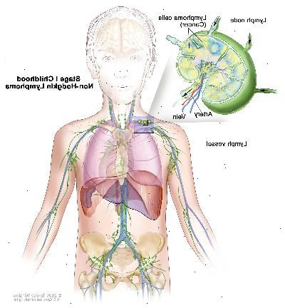 Steg I barndom Non-Hodgkins lymfom; ritningen visar cancer i en grupp av lymfkörtlar. En infällda bilden visar en lymfkörtel med en lymfkärl, en artär och en ven. Lymfomceller som innehåller cancer visas i lymfkörtel.