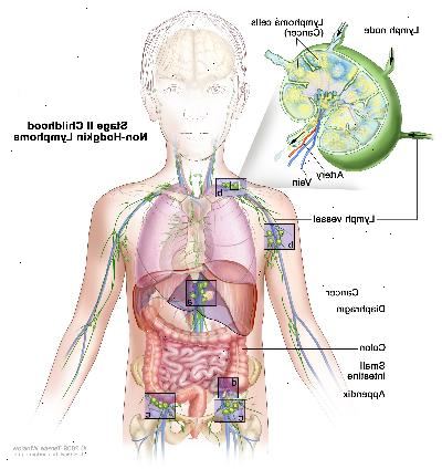 Steg II barndom non-Hodgkin lymfom, ritning visar cancer i lymfkörtelgrupperna över och under membranet, i levern, och i bilagan. Tjocktarmen och tunntarmen visas också. En infällda bilden visar en lymfkörtel med en lymfkärl, en artär och en ven. Lymfomceller som innehåller cancer visas i lymfkörtel.