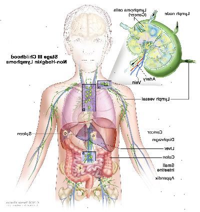 Steg III barndom non-Hodgkin lymfom, ritning visar cancer i lymfkörtelgrupperna över och under membranet, i bröstet, och hela buken i lever, mjälte, tunntarm, och appendix. Tjocktarmen visas också. En infällda bilden visar en lymfkörtel med en lymfkärl, en artär och en ven. Lymfomceller som innehåller cancer visas i lymfkörtel.
