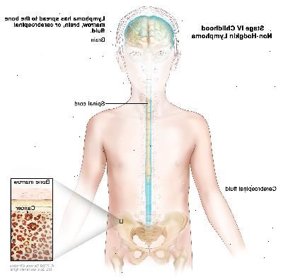 Steg IV barndom non-Hodgkin lymfom, ritning visar hjärnan, ryggmärgen och ryggmärgsvätska i och runt hjärnan och ryggmärgen. En infällda bilden visar cancer i benmärgen.