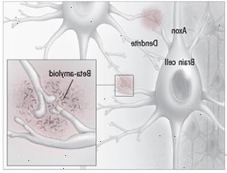 Beta-amyloid plack