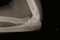 En bild av en röntgenbild av armbågen