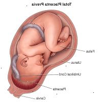 Illustration demonstrera totala placenta förhandsgranskning