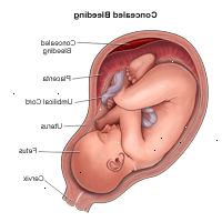 Illustration demonstrera dold blödning under graviditeten