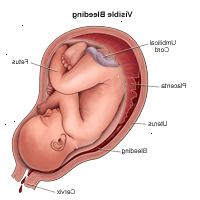 Illustration som visar synlig blödning under graviditeten