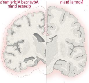 Hjärn förändringar i Alzheimers sjukdom