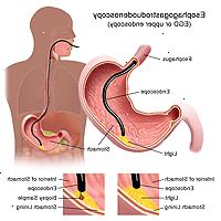 Illustration av en esophagogastroduodenoscopy förfarande