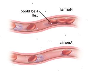 Tvärsnitt av blodkärl med normala mängder av röda blodceller. Nedanför det är ett annat tvärsnitt av blodkärl visar för få röda blodkroppar på grund av anemi.