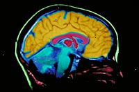 En bild av en MR hjärnskanning film