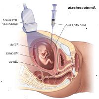 Illustration som visar ett fostervattensprov