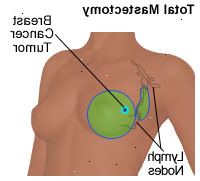 Illustration av en total mastektomi