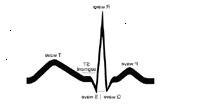 Illustration av en grundläggande EKG spårning