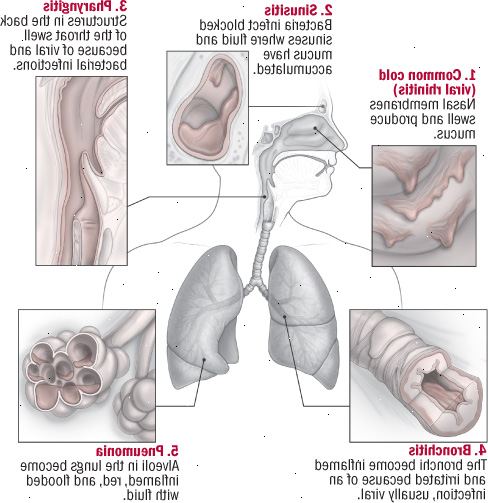 Fem luftvägsinfektioner
